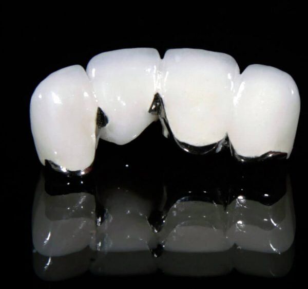 Cách nhận biết răng sứ kim loại?