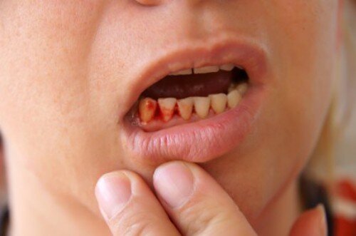 Chảy máu chân răng là dấu hiệu của bệnh gì ?