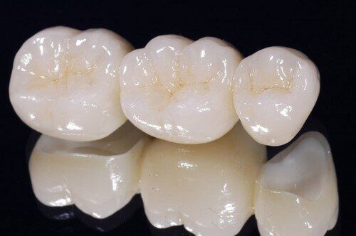 Có nên bọc răng sứ Titan cho răng cửa không?