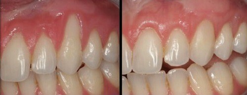 Image result for ghép nướu răng