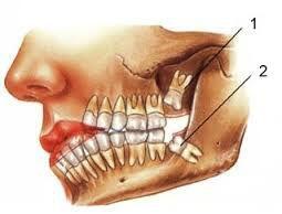 Răng khôn và cách xử trí