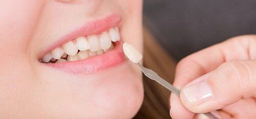 Răng sứ Veneer sử dụng được bao lâu thì phải thay lại?
