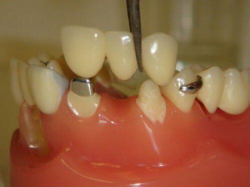 Trồng răng giả có ảnh hưởng gì không ? 