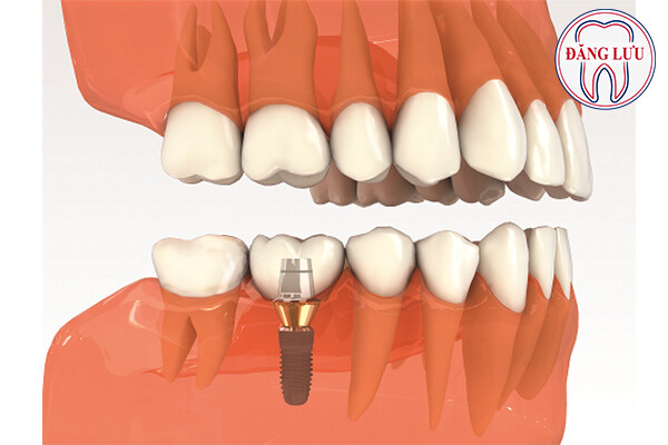 địa chỉ trồng răng implant uy tín