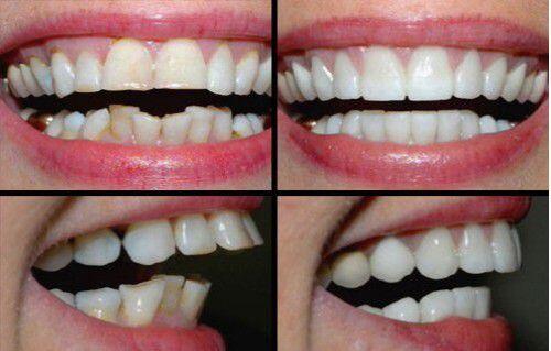 Bọc răng sứ cho răng cửa 2
