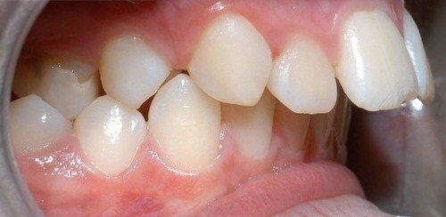 Bọc răng sứ cho răng hô 3