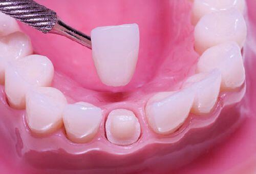 Bọc răng sứ cho trường hợp răng nhiễm màu nặng