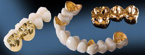 Bọc răng sứ kim loại có những lợi ích gì?