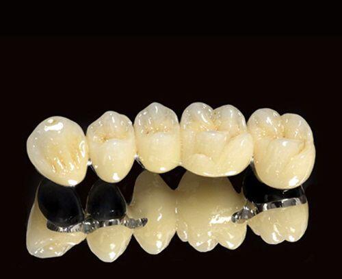 Ưu và nhược điểm của các loại răng sứ 1