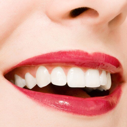 Ưu điểm răng toàn sứ so với răng sứ kim loại
