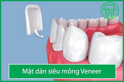 Bọc răng sứ Veneer giá bao nhiêu tiền ? 1