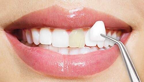 Bọc răng sứ Veneer giá bao nhiêu tiền ? 2