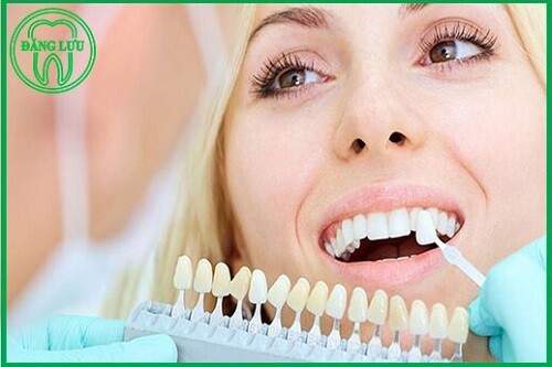 Bọc răng sứ Veneer giá bao nhiêu tiền ? 3