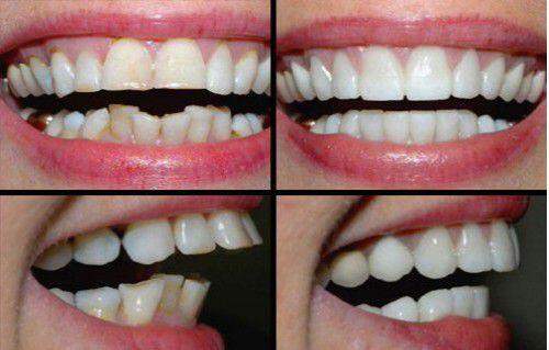 Các dạng điển hình của mọc răng không thẩm mỹ 4