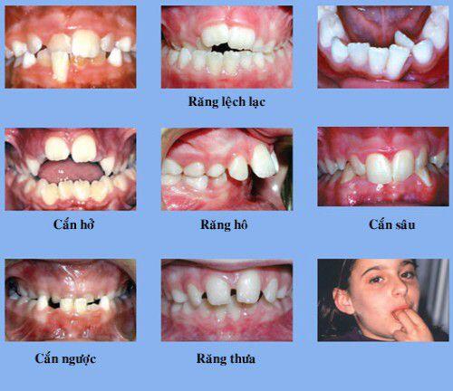 Nguyên nhân và tác hại của răng mọc chen chúc