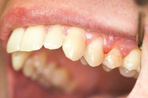 Nhiễm khuẩn sau khi nhổ răng là gì ?
