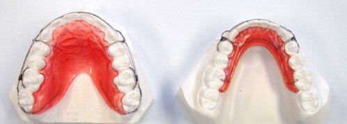 Các loại hàm duy trì sau niềng răng