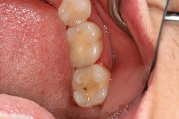 Các triệu chứng của bệnh sâu răng cần được nhận diện kịp thời