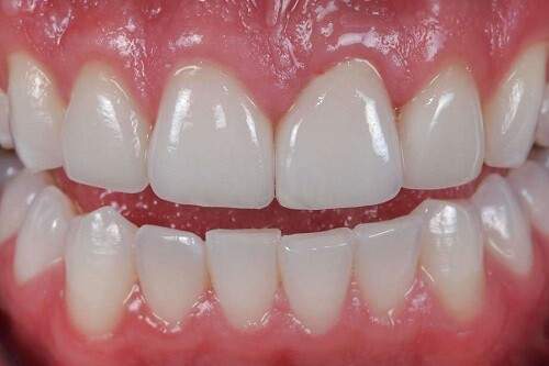 Cách chữa thiếu sản men răng 3