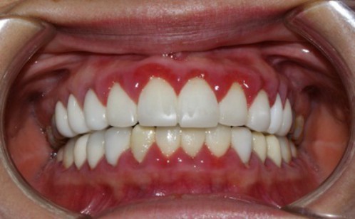 Nguyên nhân hôi miệng sau khi trồng răng