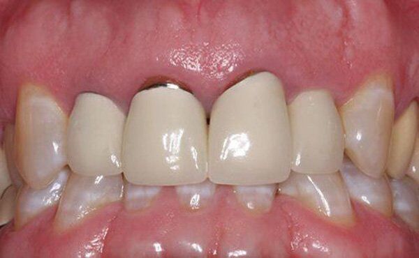 cách khắc phục viêm lợi sau khi bọc răng sứ