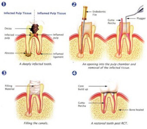 Cách phòng ngừa viêm tủy răng hiệu quả