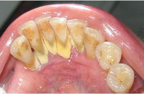 Cạo vôi răng có tác dụng gì ?