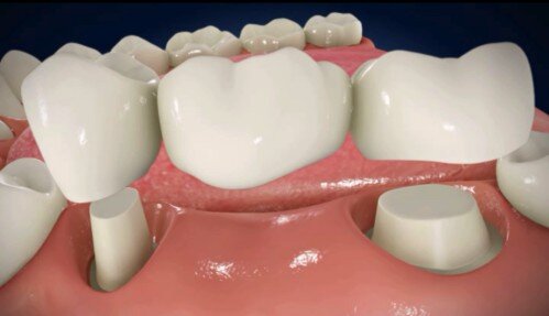 Tất tần tật về phương pháp phục hình cầu răng