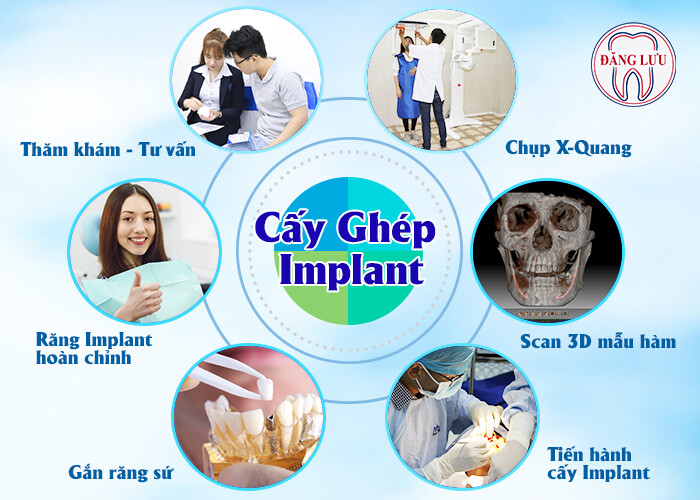 cay-implant-chiu-luc-tuc-thi-1