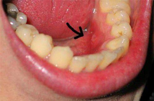 Nhiễm khuẩn sau khi nhổ răng là gì ?
