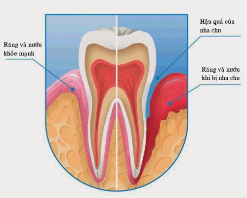 Chảy máu chân răng có phải là dấu hiệu của bệnh răng miệng