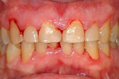 Nguyên nhân nướu răng bị chảy máu 1