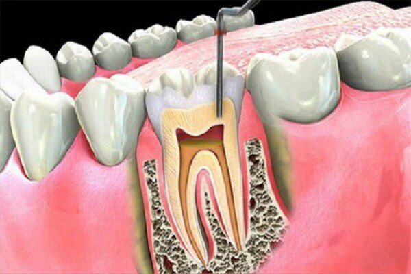 chữa tủy răng
