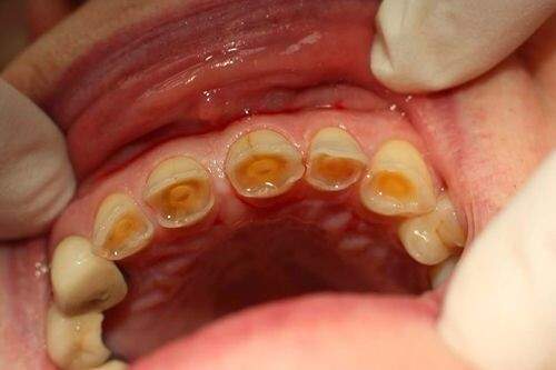 Có cách điều trị dứt điểm để bệnh thiếu sản men răng không ? 1