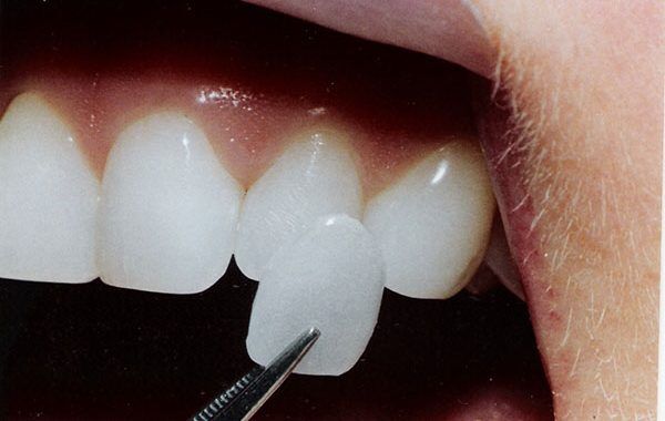 Có nên làm răng sứ Veneer cho răng cửa bị mẻ hay không?