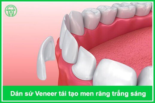 dán răng sứ Veneer