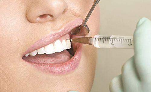 Cách điều trị viêm tủy răng hiệu quả