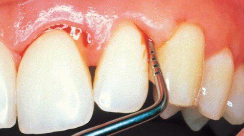 Dấu hiệu và triệu chứng bệnh viêm chân răng 1