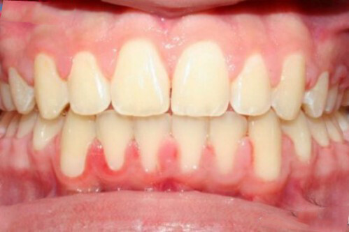 4 dấu hiệu răng miệng cảnh báo bệnh nguy hiểm
