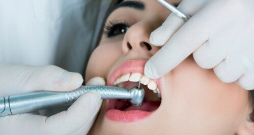 Dịch vụ trám răng thẩm mỹ tại trung tâm nha khoa