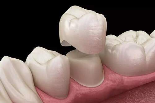 Độ bền của răng sứ thẩm mỹ 4