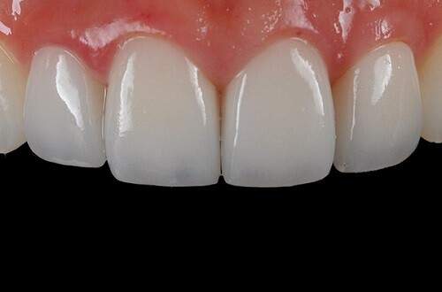 Độ bền của răng sứ thẩm mỹ 5