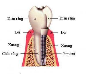 Độ Tuổi Cấy Ghép Răng Implant Tốt Nhất