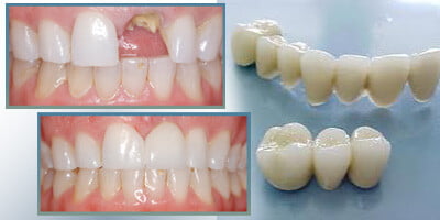 Giải pháp hữu hiệu cho răng sâu