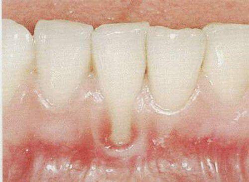 Đánh răng quá nhiều gây mòn răng, tụt lợi