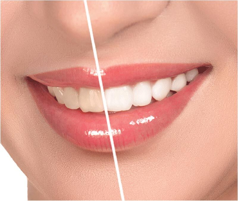 Hướng dẫn sử dụng thuốc tẩy trắng răng tại nhà -3