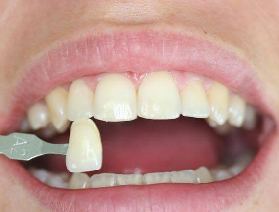 Khi nào nên sử dụng sứ Veneer để làm răng