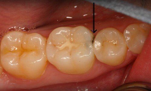 Chảy máu răng ở trẻ nhỏ có nguy hiểm không? 3