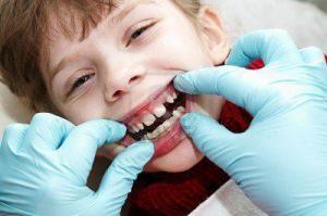 Làm sao phát hiện sớm răng mọc lệch ở trẻ em