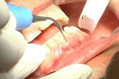 Cách chữa viêm lợi hở quanh chân răng 4